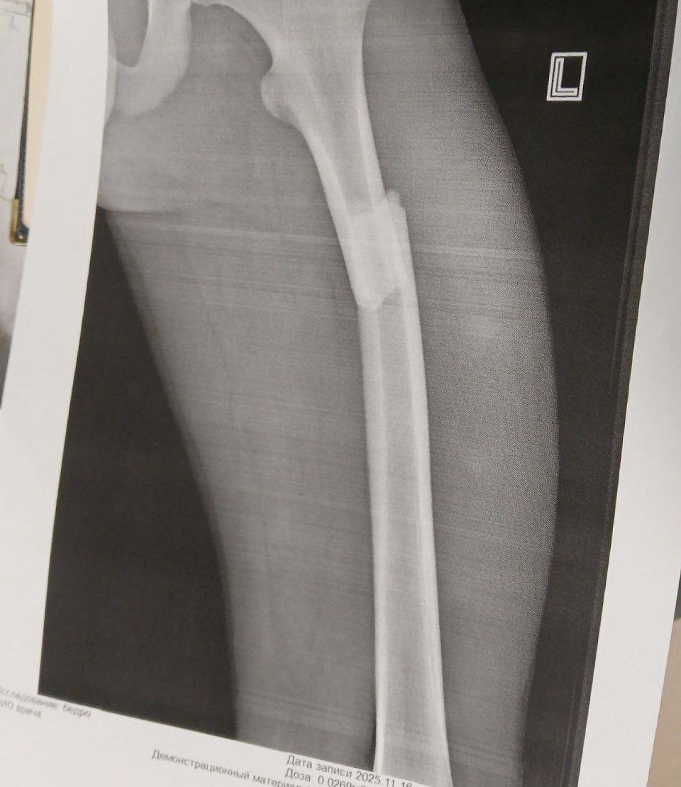 От подписчика из Магнитогорска:

Ехал около 60 км/ч, отвлекся на звук цепи буквально полсекунды - обнял столб, сломал бедро