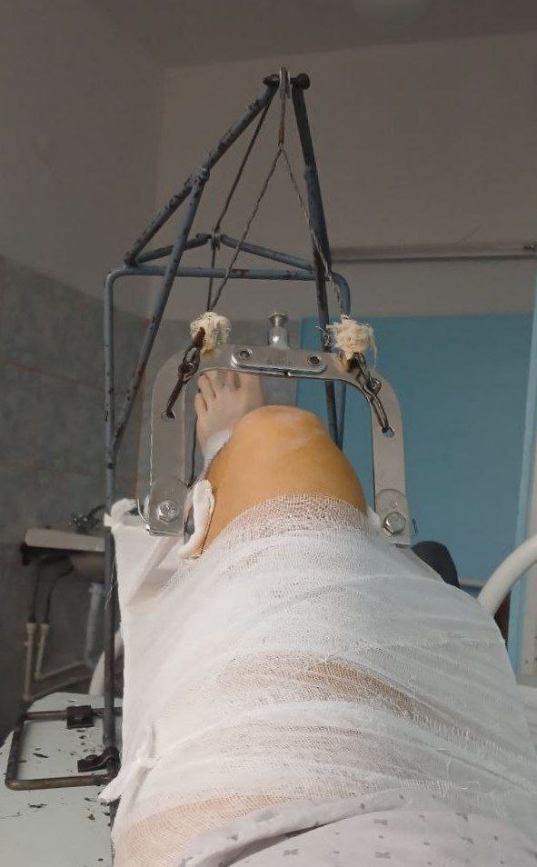 От подписчика из Магнитогорска:

Ехал около 60 км/ч, отвлекся на звук цепи буквально полсекунды - обнял столб, сломал бедро